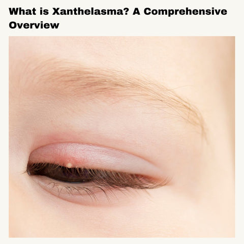 What is Xanthelasma? A Comprehensive Overview