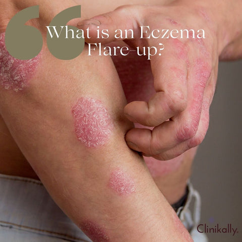 What is an Eczema Flare-up?