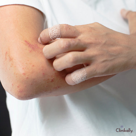 How do antidepressants affect your skin?