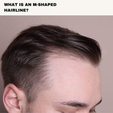 What is an M-Shaped Hairline?