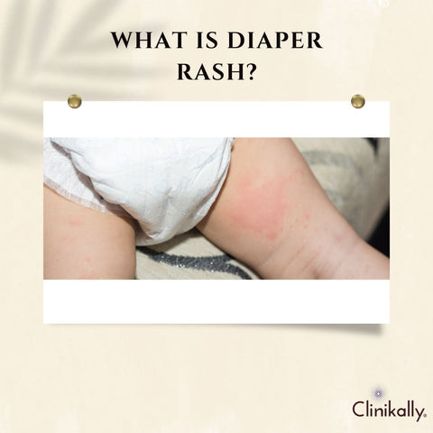 What is diaper rash?