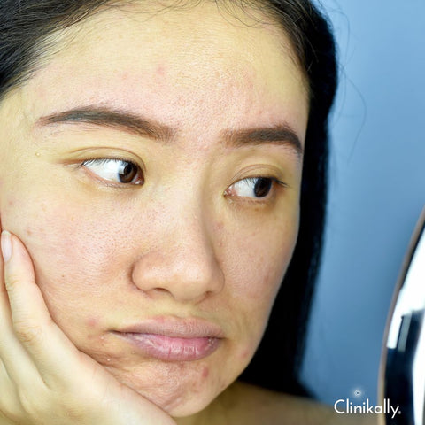 What is dull dry skin