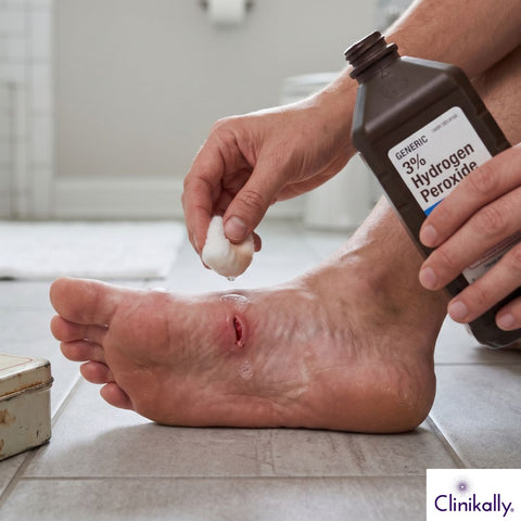 Hydrogen peroxide on foot wound treatment