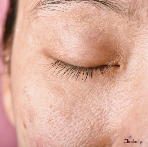 whiteheads removal