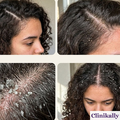 Dandruff buildup