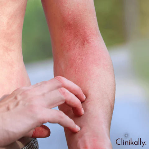Allergic reactions or sensitivities