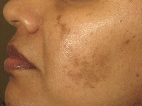 What is broken or compromised skin?