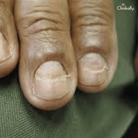 beau lines on nails