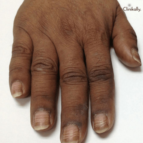 beau lines on nails