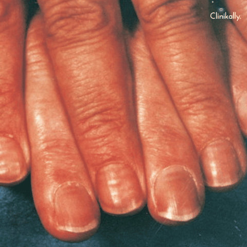 beau lines on nails