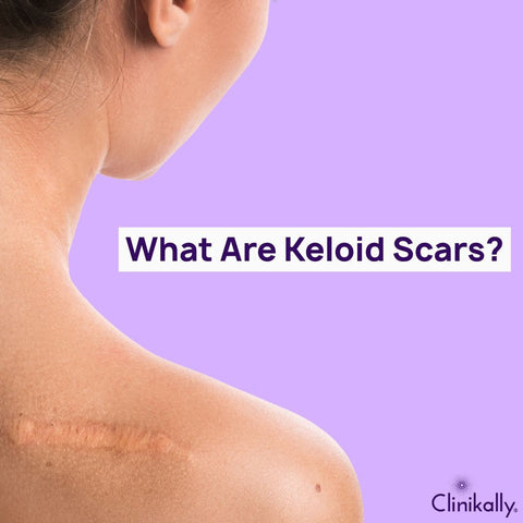 What Are Keloid Scars?