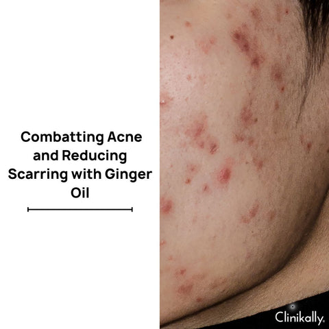 Combatting Acne and Reducing Scarring with Ginger Oil