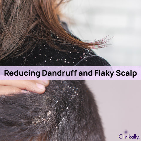 Reducing Dandruff and Flaky Scalp