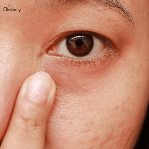 eyelid eczema 