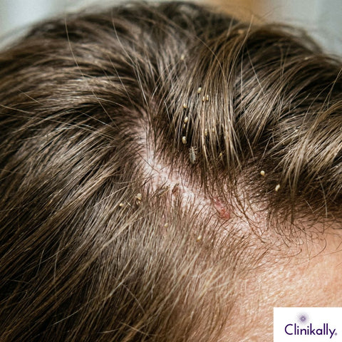A women with ticks on her hair.