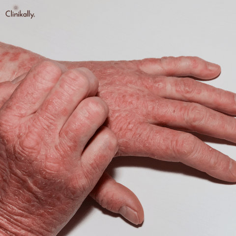 viral rash