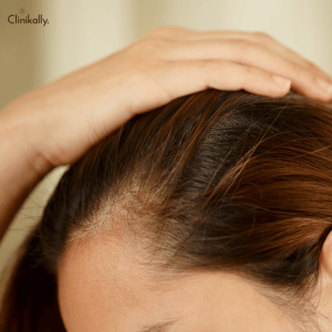 hair fall after delivery