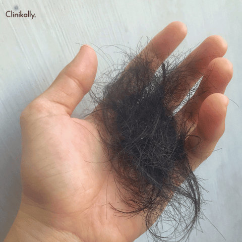 hair fall after delivery