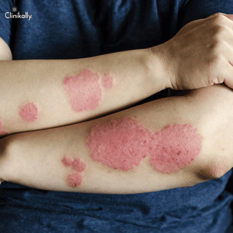 psoriasis treatment