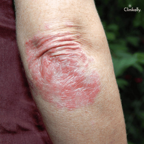 metronidazole uses