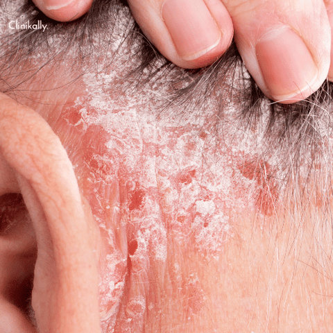 psoriasis treatment 