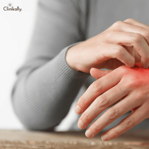 psoriasis treatment