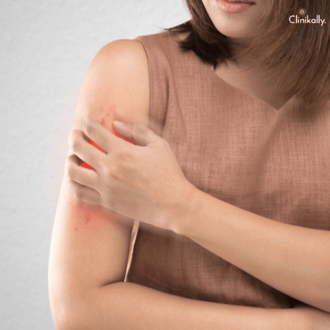 psoriasis treatment