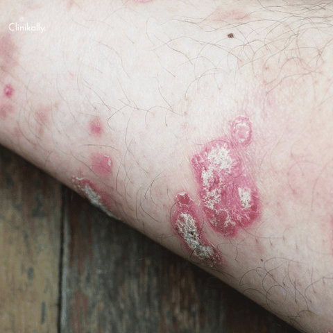prurigo nodularis