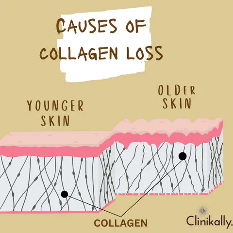 Causes of collagen loss