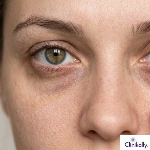A women with dark circles