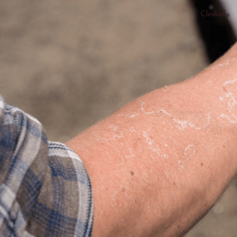 Skin Flakes
