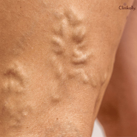 varicose veins