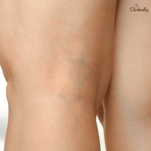 varicose veins