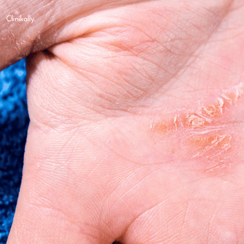 Skin Flakes