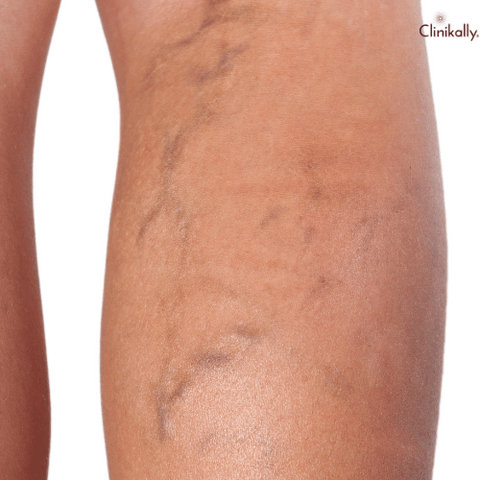 varicose veins