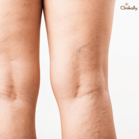 varicose veins