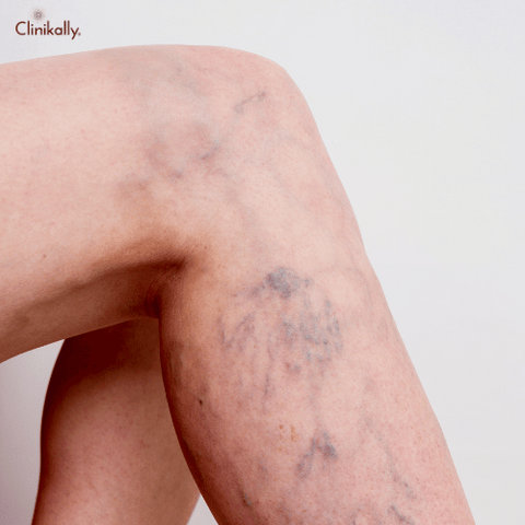 varicose veins