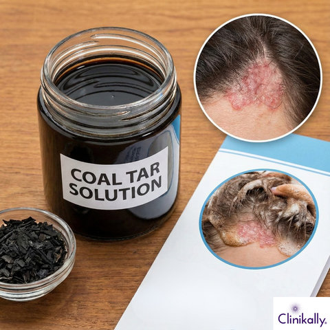 Coal tar treatment for scalp condition