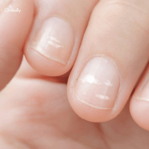 white nail spots