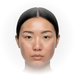 Acne & Scars