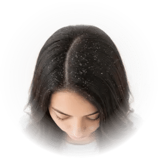 Dandruff